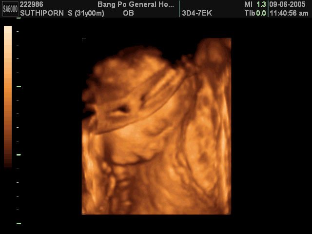 fetus at 12 weeks. unborn aby fowler weeks